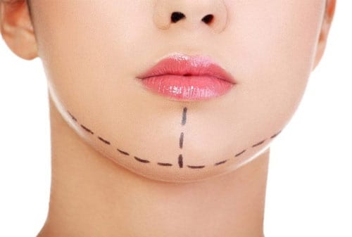 Tren Operasi Plastik 4 Finansialku