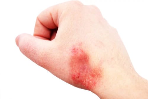 Cara Pengobatan Penyakit Kulit 04 (Eksim atau Dermatitis) - Finansialku